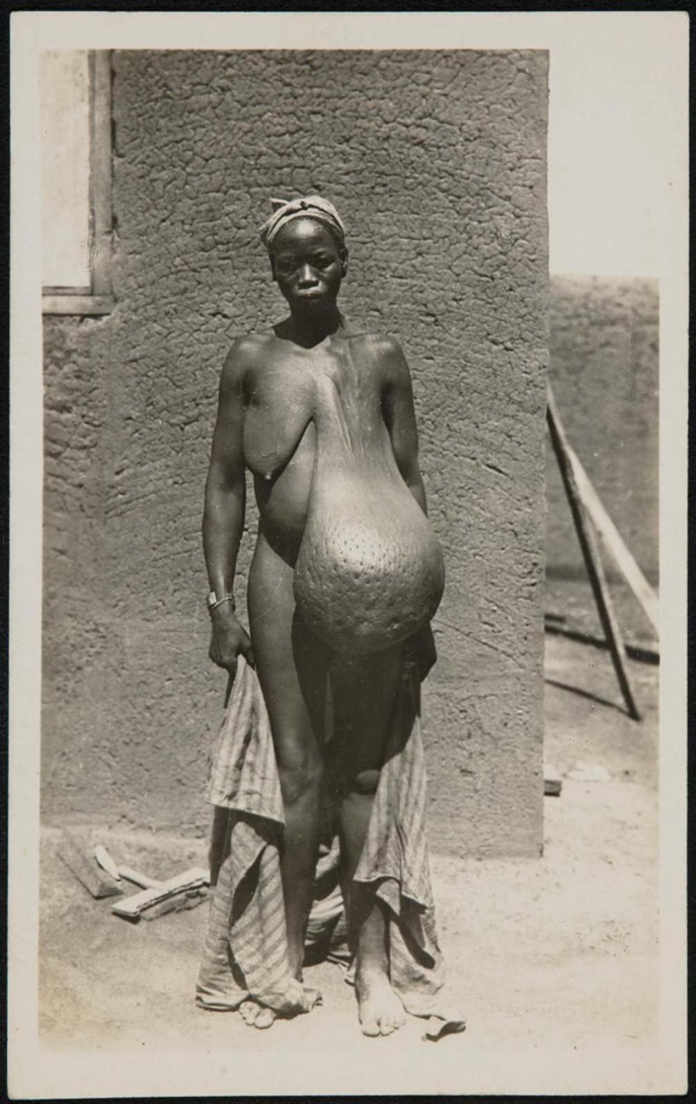 Woman with a breast enlarged by elephantiasis - Stock Image - M160